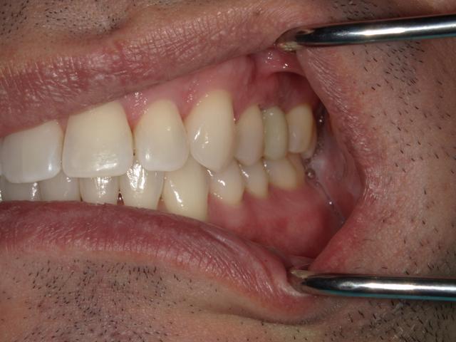 Dental Implants after at Westwood Family and Cosmetic Dentistry, Dr. David Reynolds DDS in Draper, UT