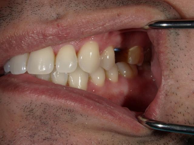 Dental Implants before at Westwood Family and Cosmetic Dentistry, Dr. David Reynolds DDS in Draper, UT