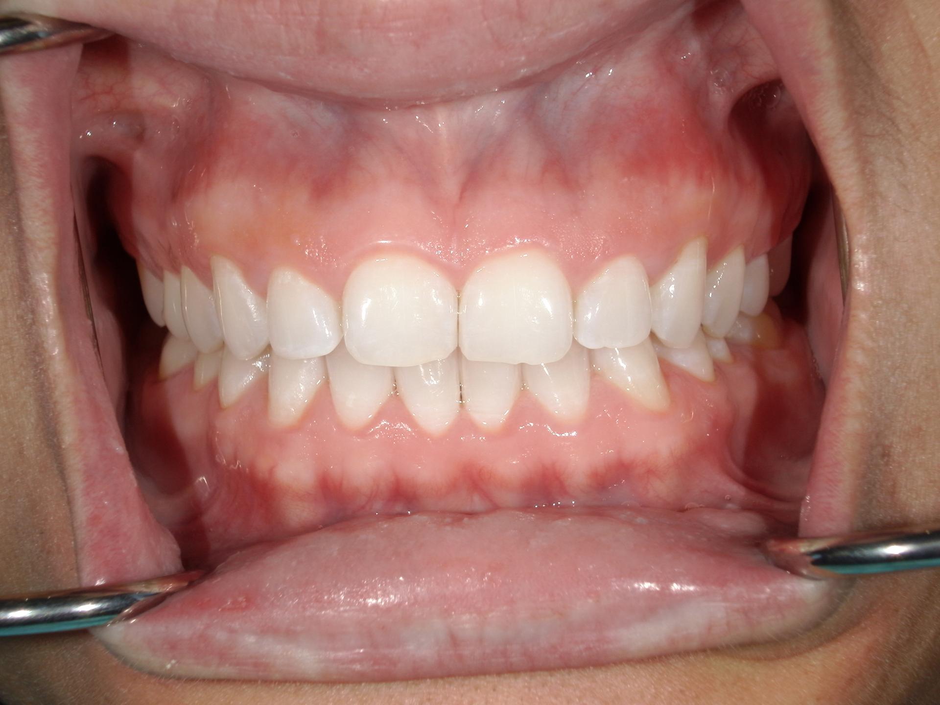 Westwood Family and Cosmetic Dentistry, Dr. David Reynolds DDS veneers after — Draper, UT