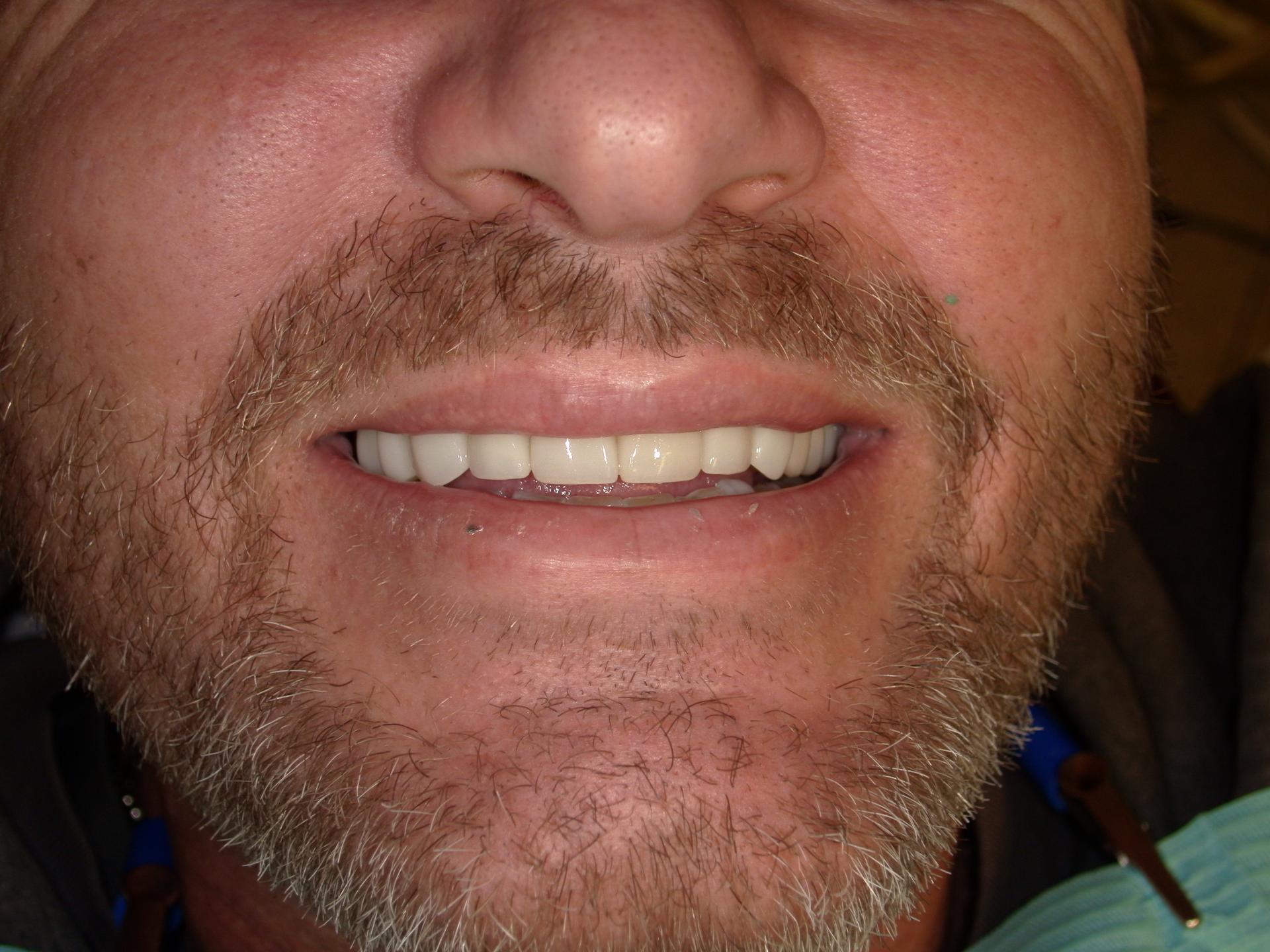Westwood Family and Cosmetic Dentistry, Dr. David Reynolds DDS dental crowns after — Draper, UT