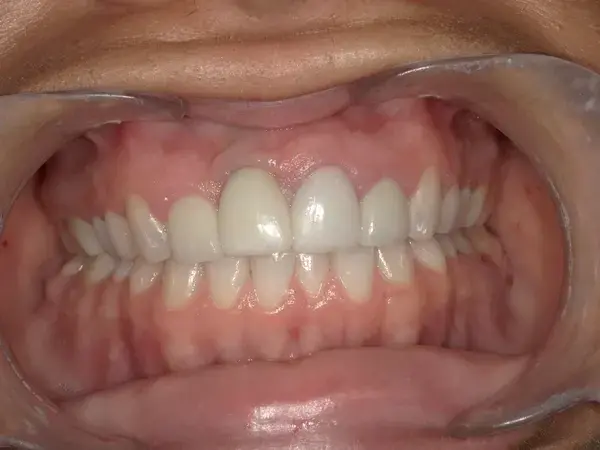Dental Implants before at Westwood Family and Cosmetic Dentistry, Dr. David Reynolds DDS in Draper, UT