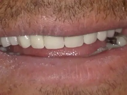 Smile Makeover after at Westwood Family and Cosmetic Dentistry, Dr. David Reynolds DDS in Draper, UT