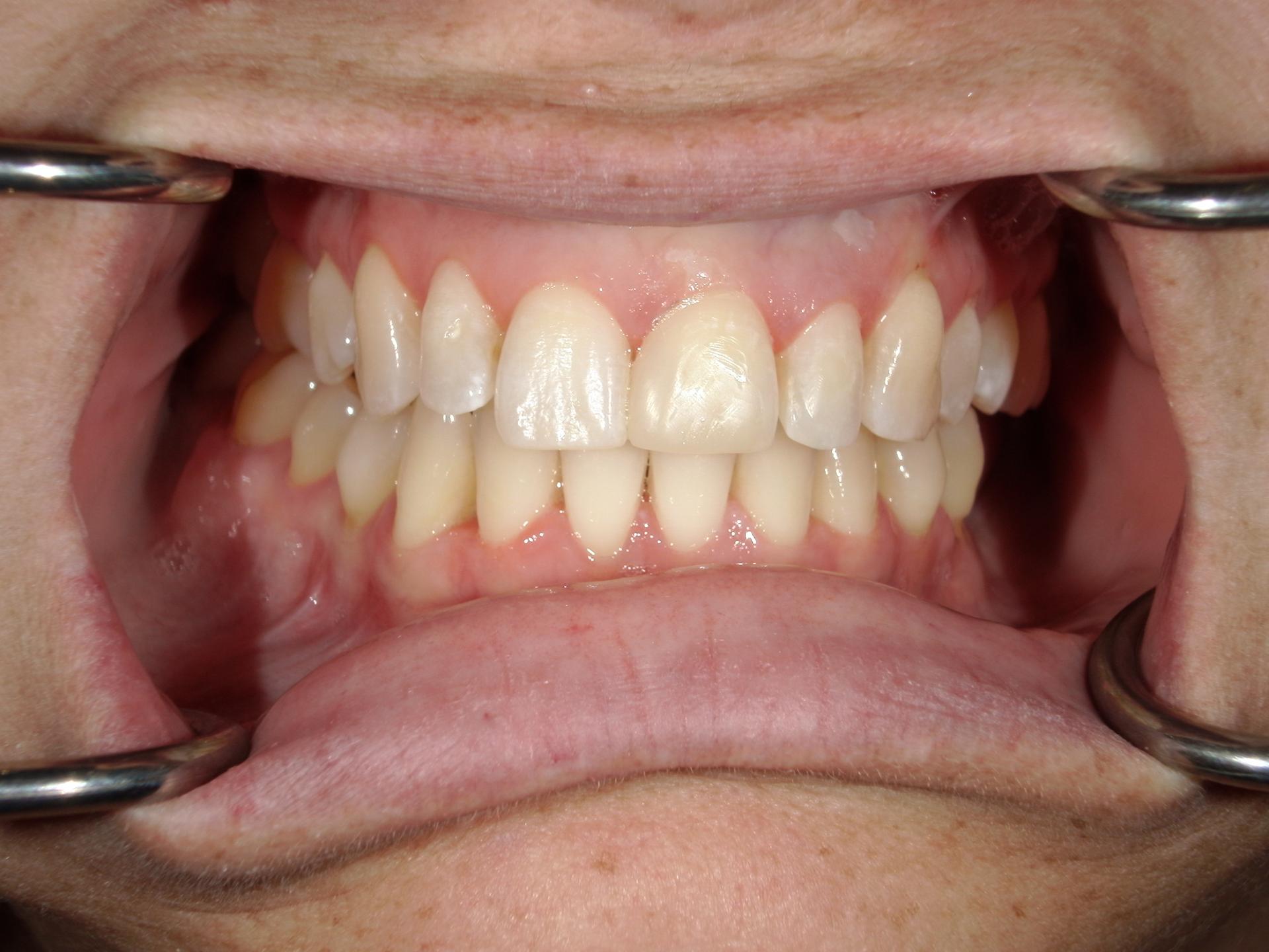 Westwood Family and Cosmetic Dentistry, Dr. David Reynolds DDS dental bonding after — Draper, UT