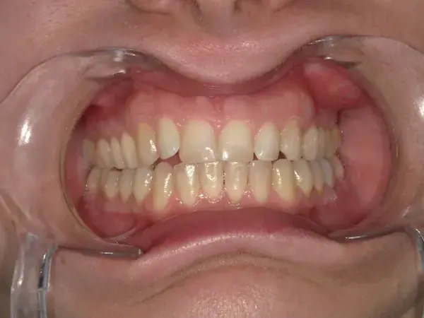Westwood Family and Cosmetic Dentistry, Dr. David Reynolds DDS dental bonding after — Draper, UT