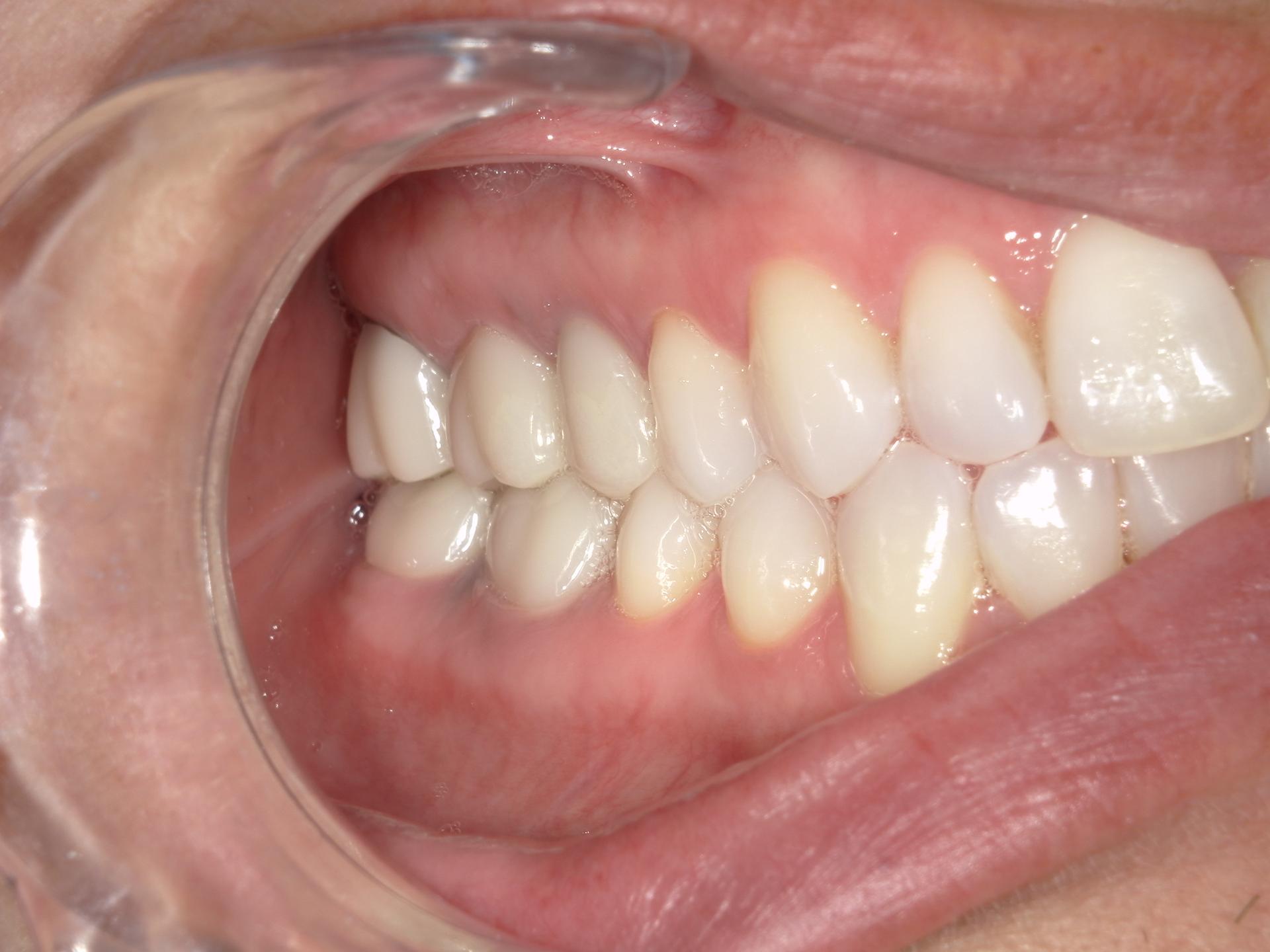 Westwood Family and Cosmetic Dentistry, Dr. David Reynolds DDS veneers after — Draper, UT