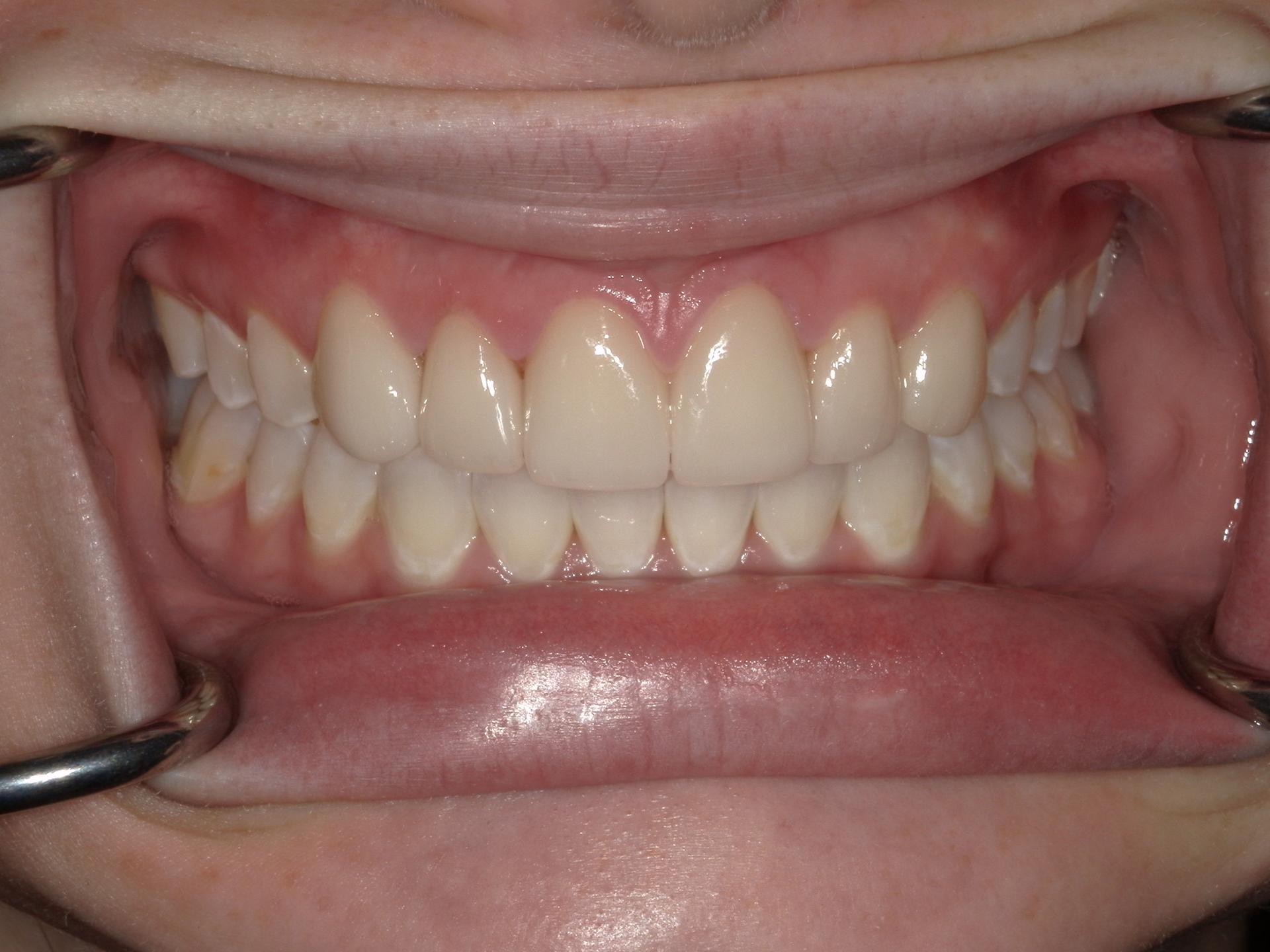 Westwood Family and Cosmetic Dentistry, Dr. David Reynolds DDS dental crowns after — Draper, UT