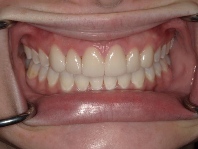 Dental Veneers after at Westwood Family and Cosmetic Dentistry, Dr. David Reynolds DDS in Draper, UT