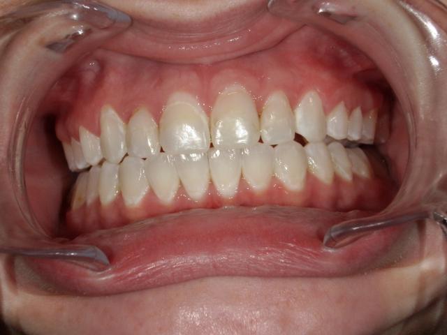 Dental Veneers before at Westwood Family and Cosmetic Dentistry, Dr. David Reynolds DDS in Draper, UT