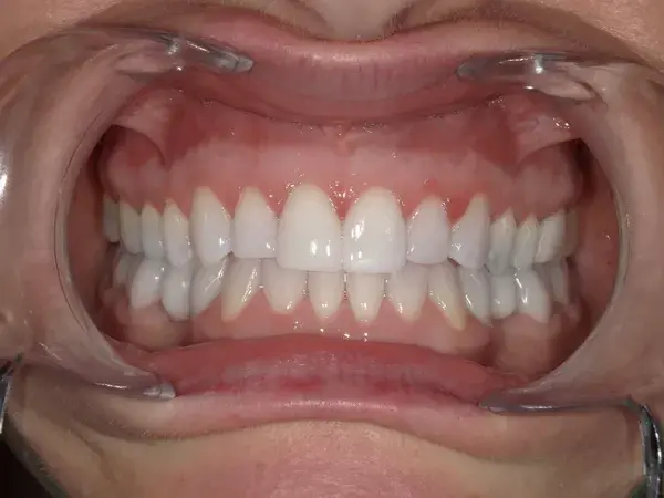 Westwood Family and Cosmetic Dentistry, Dr. David Reynolds DDS dental crowns after — Draper, UT