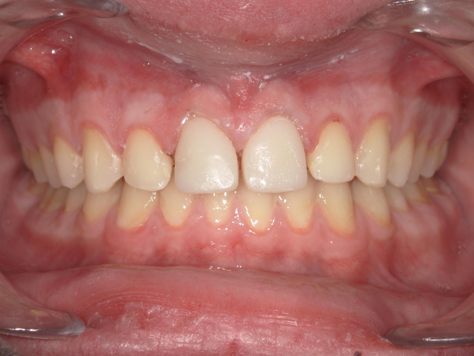Westwood Family and Cosmetic Dentistry, Dr. David Reynolds DDS veneers after — Draper, UT