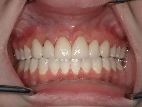 Dental Crowns after at Westwood Family and Cosmetic Dentistry, Dr. David Reynolds DDS in Draper, UT
