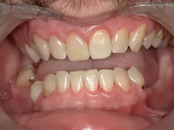 Westwood Family and Cosmetic Dentistry, Dr. David Reynolds DDS dental bonding after — Draper, UT