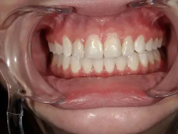 Dental Crowns before at Westwood Family and Cosmetic Dentistry, Dr. David Reynolds DDS in Draper, UT