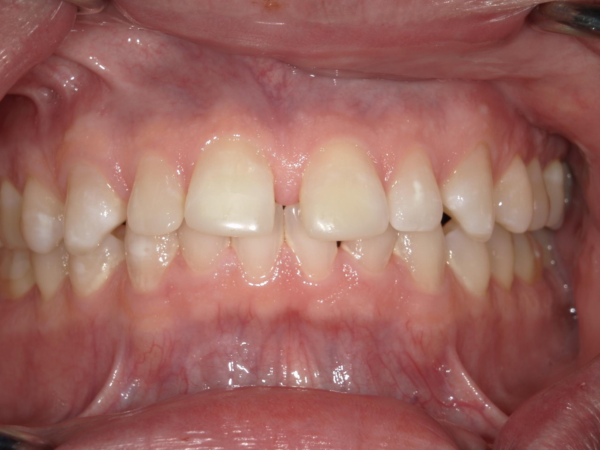 Westwood Family and Cosmetic Dentistry, Dr. David Reynolds DDS veneers after — Draper, UT