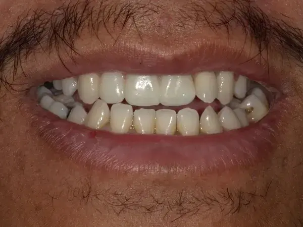 Westwood Family and Cosmetic Dentistry, Dr. David Reynolds DDS smile makeover after — Draper, UT
