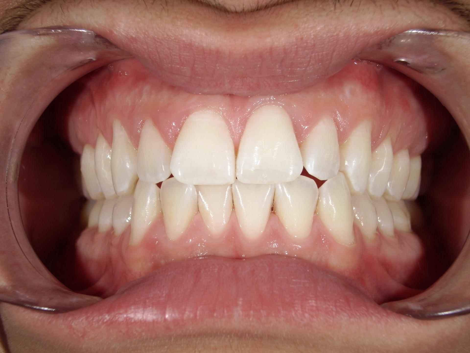 Westwood Family and Cosmetic Dentistry, Dr. David Reynolds DDS veneers after — Draper, UT