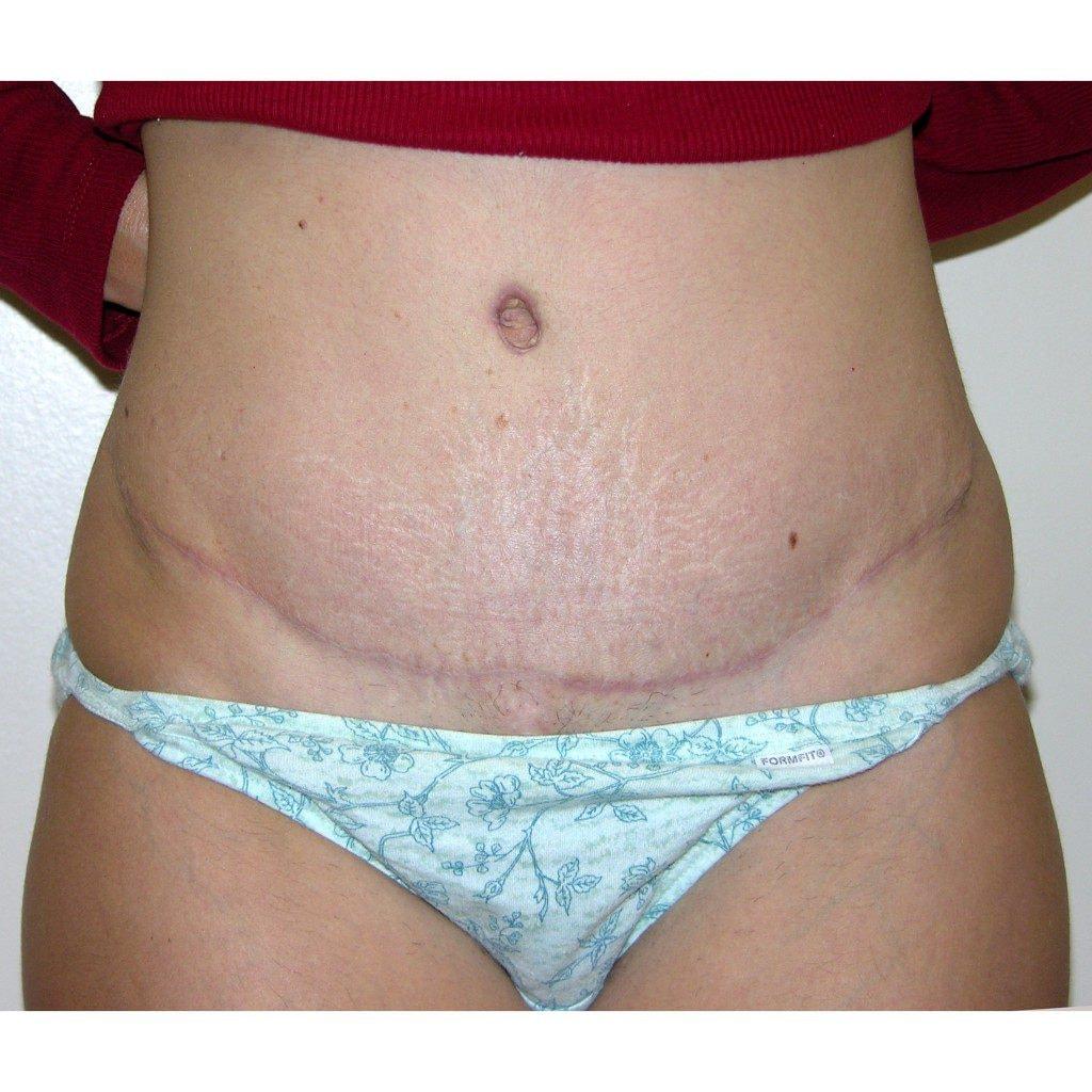 J. Brian Boyd, MD tummy tuck after — Rolling Hills Estates, CA