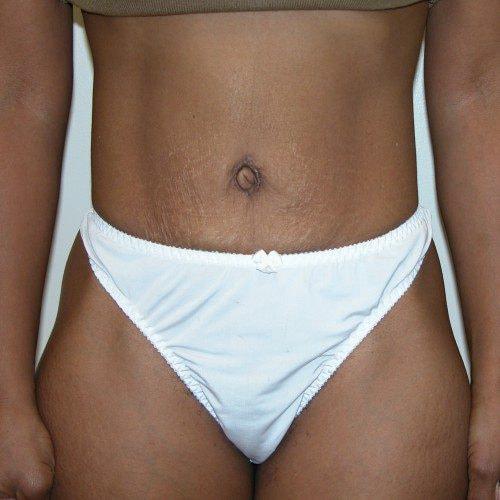 J. Brian Boyd, MD tummy tuck after — Rolling Hills Estates, CA