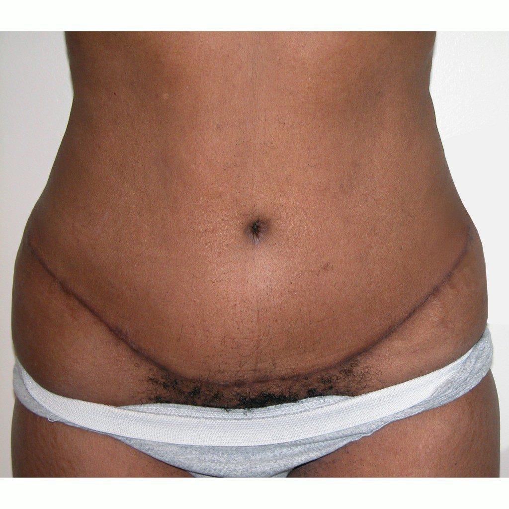 J. Brian Boyd, MD tummy tuck after — Rolling Hills Estates, CA