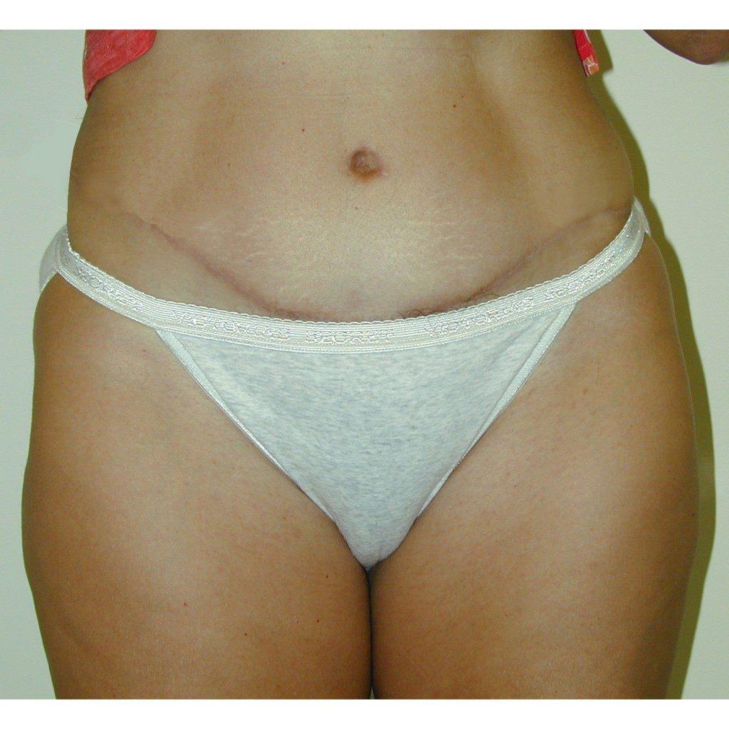 J. Brian Boyd, MD tummy tuck after — Rolling Hills Estates, CA