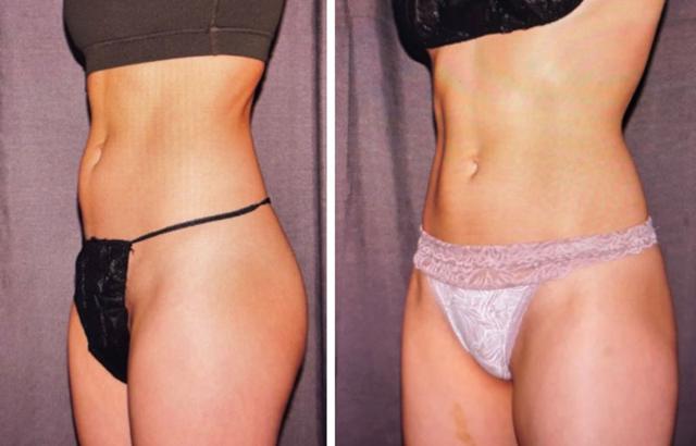 CoolSculpting result at Evolve Medical Associates in Charlotte, NC
