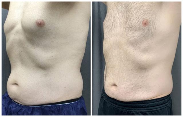 Liposuction result at Evolve Medical Associates in Charlotte, NC