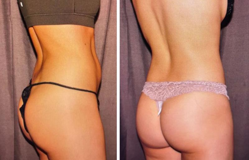 Evolve Medical Associates coolsculpting result — Charlotte, NC