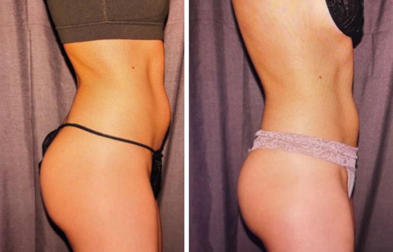 Evolve Medical Associates coolsculpting result — Charlotte, NC