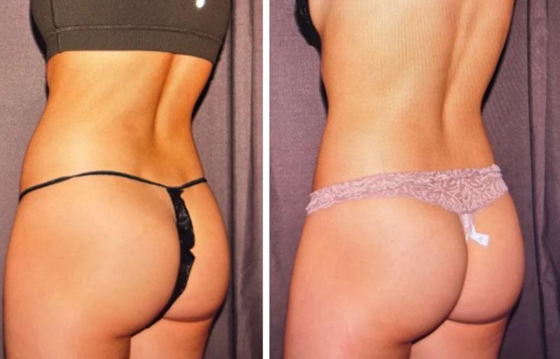 Evolve Medical Associates coolsculpting result — Charlotte, NC