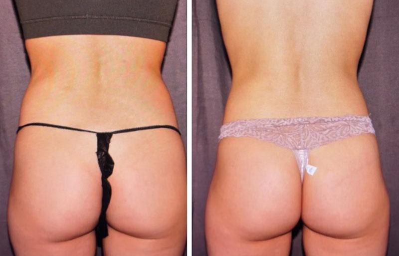 Evolve Medical Associates coolsculpting result — Charlotte, NC