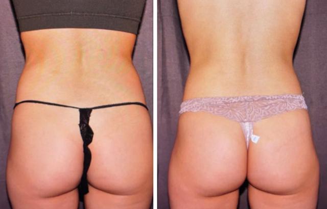 CoolSculpting result at Evolve Medical Associates in Charlotte, NC