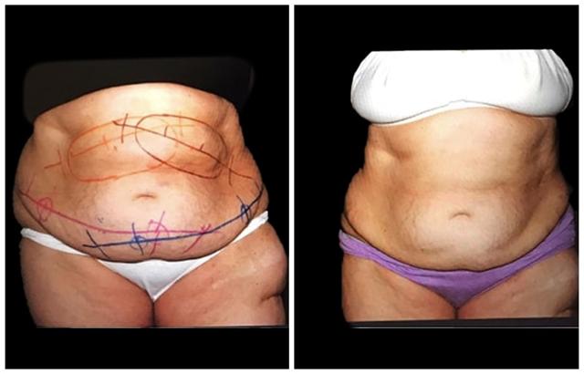 Liposuction result at Evolve Medical Associates in Charlotte, NC