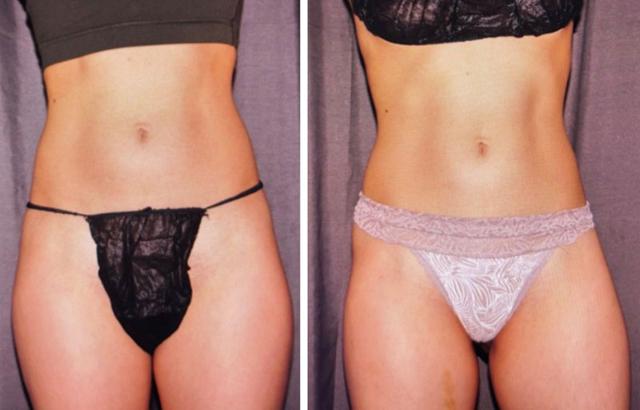 CoolSculpting result at Evolve Medical Associates in Charlotte, NC