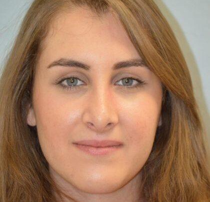 Esthetica Of San Diego and Dr. Wael Kouli rhinoplasty after — Coronado, CA