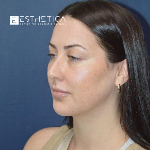 Facelift after at Esthetica Of San Diego and Dr. Wael Kouli in Coronado, CA