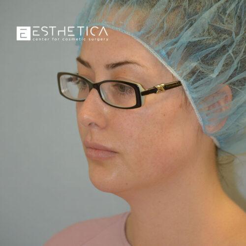 Facelift before at Esthetica Of San Diego and Dr. Wael Kouli in Coronado, CA