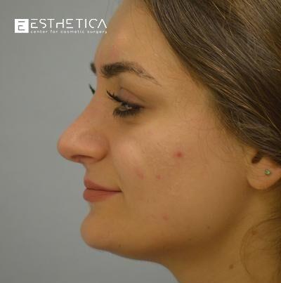 Esthetica Of San Diego and Dr. Wael Kouli rhinoplasty after — Coronado, CA