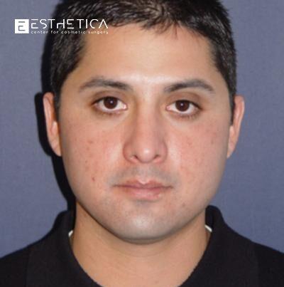 Esthetica Of San Diego and Dr. Wael Kouli rhinoplasty after — Coronado, CA