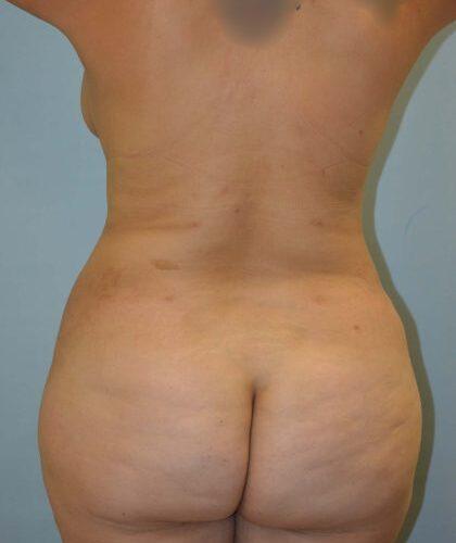 Esthetica Of San Diego and Dr. Wael Kouli after — Coronado, CA