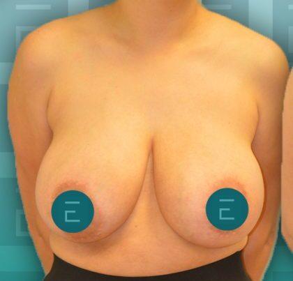 Breast Reduction before at Esthetica Of San Diego and Dr. Wael Kouli in Coronado, CA