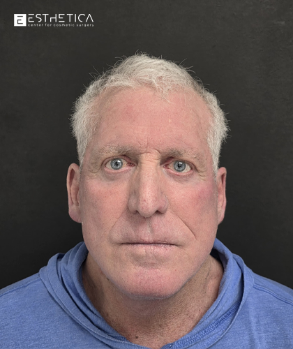 Esthetica Of San Diego and Dr. Wael Kouli facelift after — Coronado, CA