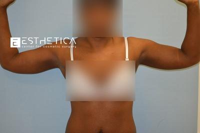 Esthetica Of San Diego and Dr. Wael Kouli after — Coronado, CA