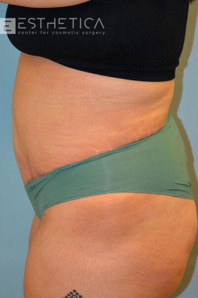 Esthetica Of San Diego and Dr. Wael Kouli after — Coronado, CA