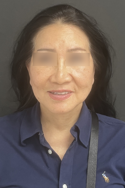 Esthetica Of San Diego and Dr. Wael Kouli facelift after — Coronado, CA