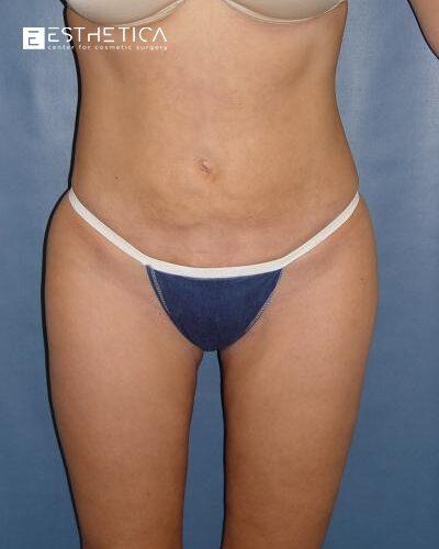 Esthetica Of San Diego and Dr. Wael Kouli after — Coronado, CA