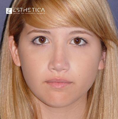 Esthetica Of San Diego and Dr. Wael Kouli rhinoplasty after — Coronado, CA