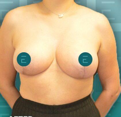 Breast Reduction after at Esthetica Of San Diego and Dr. Wael Kouli in Coronado, CA