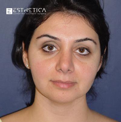 Esthetica Of San Diego and Dr. Wael Kouli rhinoplasty after — Coronado, CA