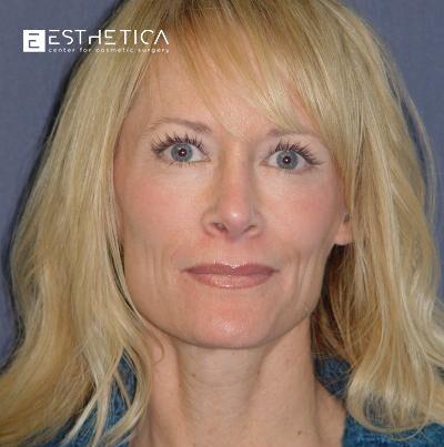 Esthetica Of San Diego and Dr. Wael Kouli rhinoplasty after — Coronado, CA