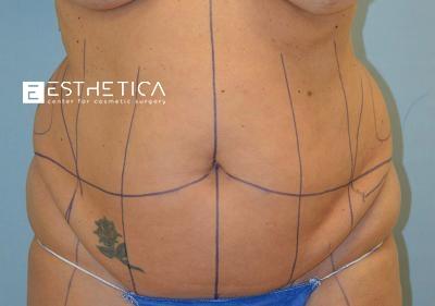 Tummy Tuck before at Esthetica Of San Diego and Dr. Wael Kouli in Coronado, CA